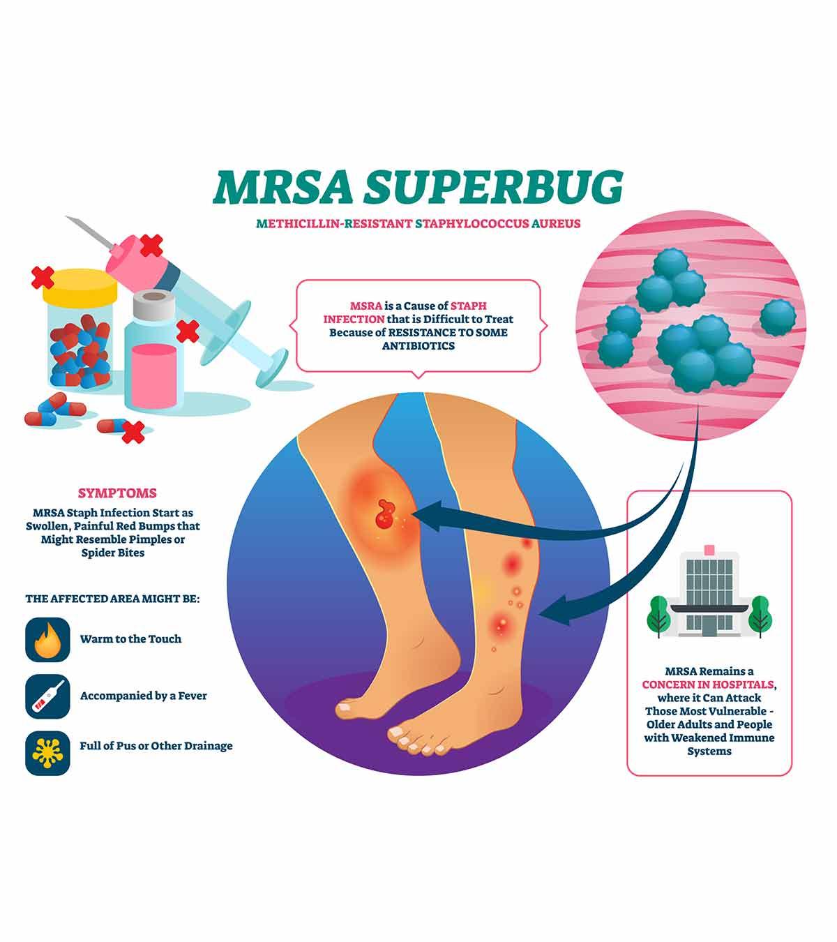 Mrsa infection in a child