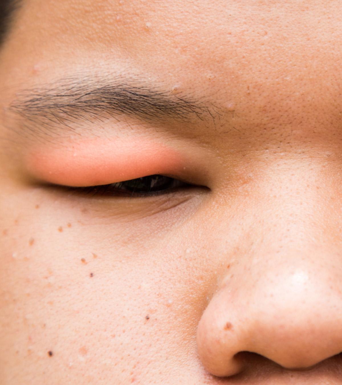 Causes Of Swollen Eyelids In Children