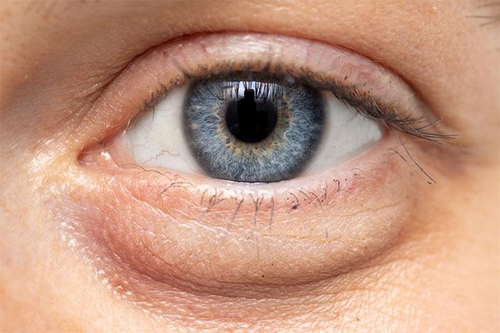 Swollen eyes - Reason and how to prevent them