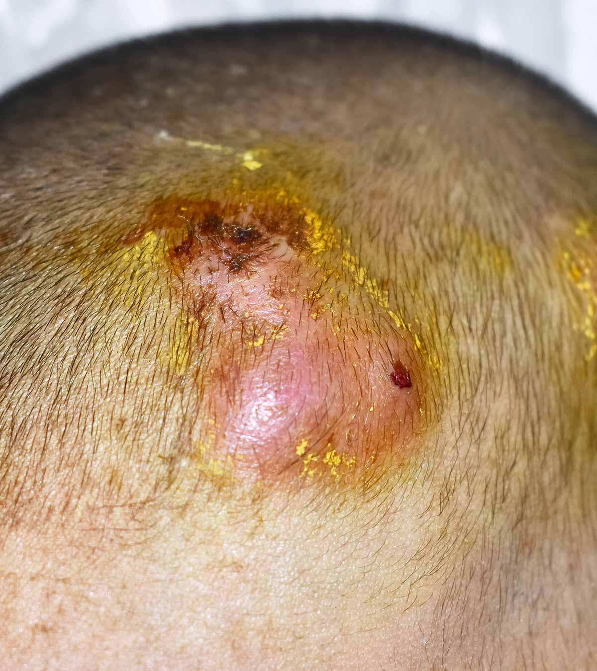 Infected Hair Follicle On Scalp Infected Hair Follicle On Scalp