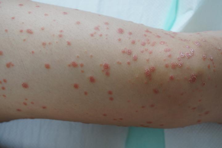 Psoriasis hands 