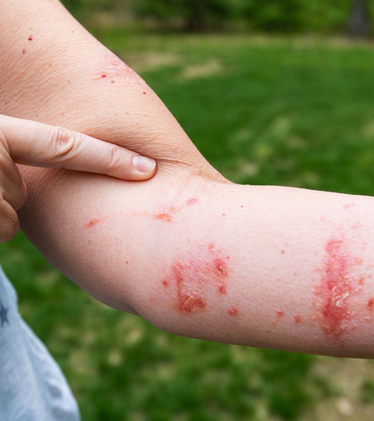 A Kid Suffering From Poison Ivy Rash On Hand