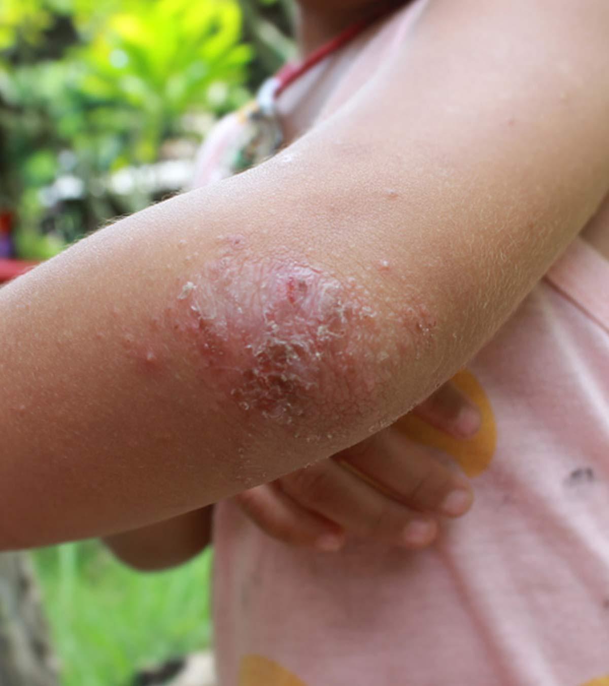Child With Psoriasis Symptoms