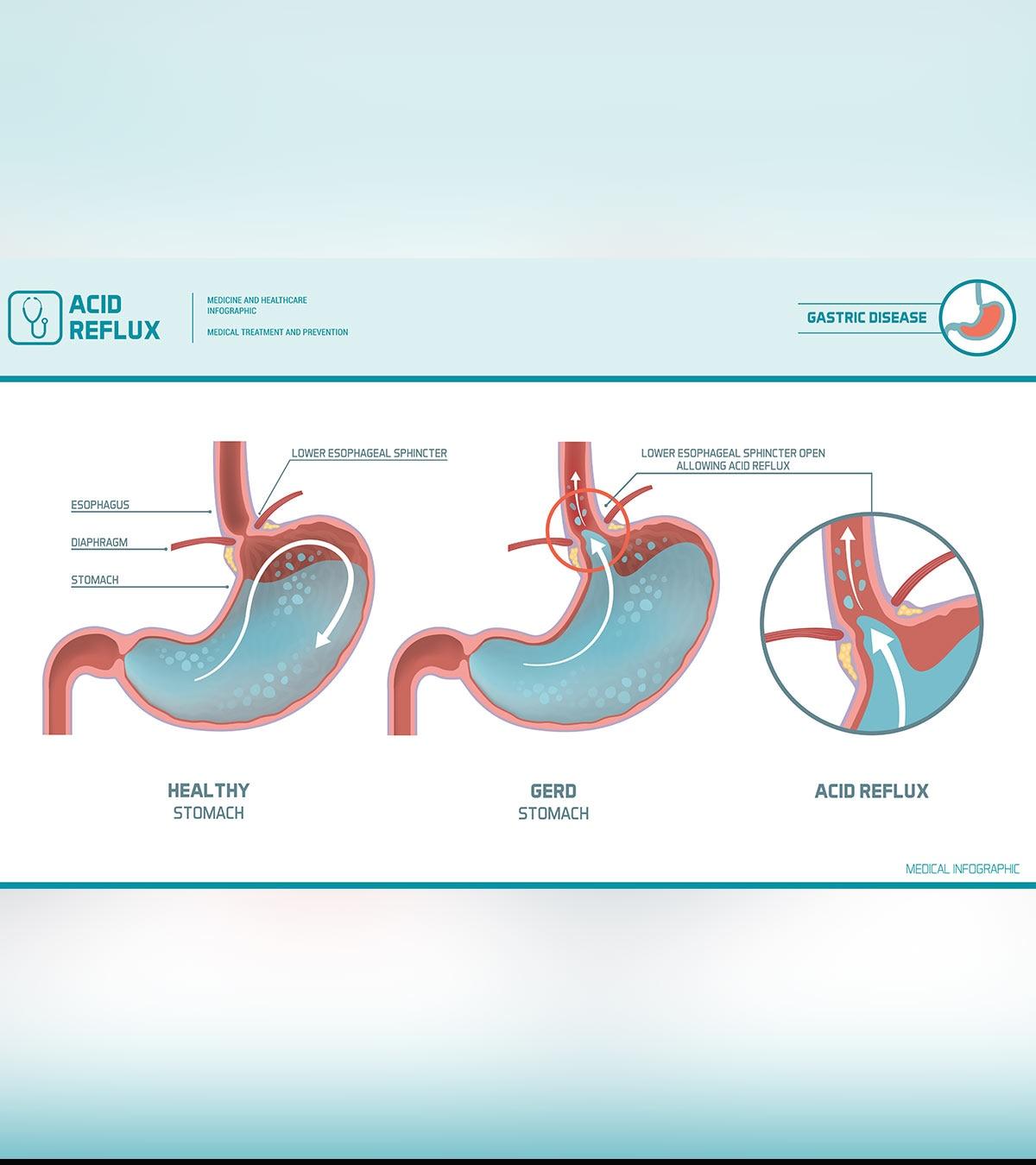 Acid Reflux (GERD) In Teens: Symptoms, Causes And Treatments