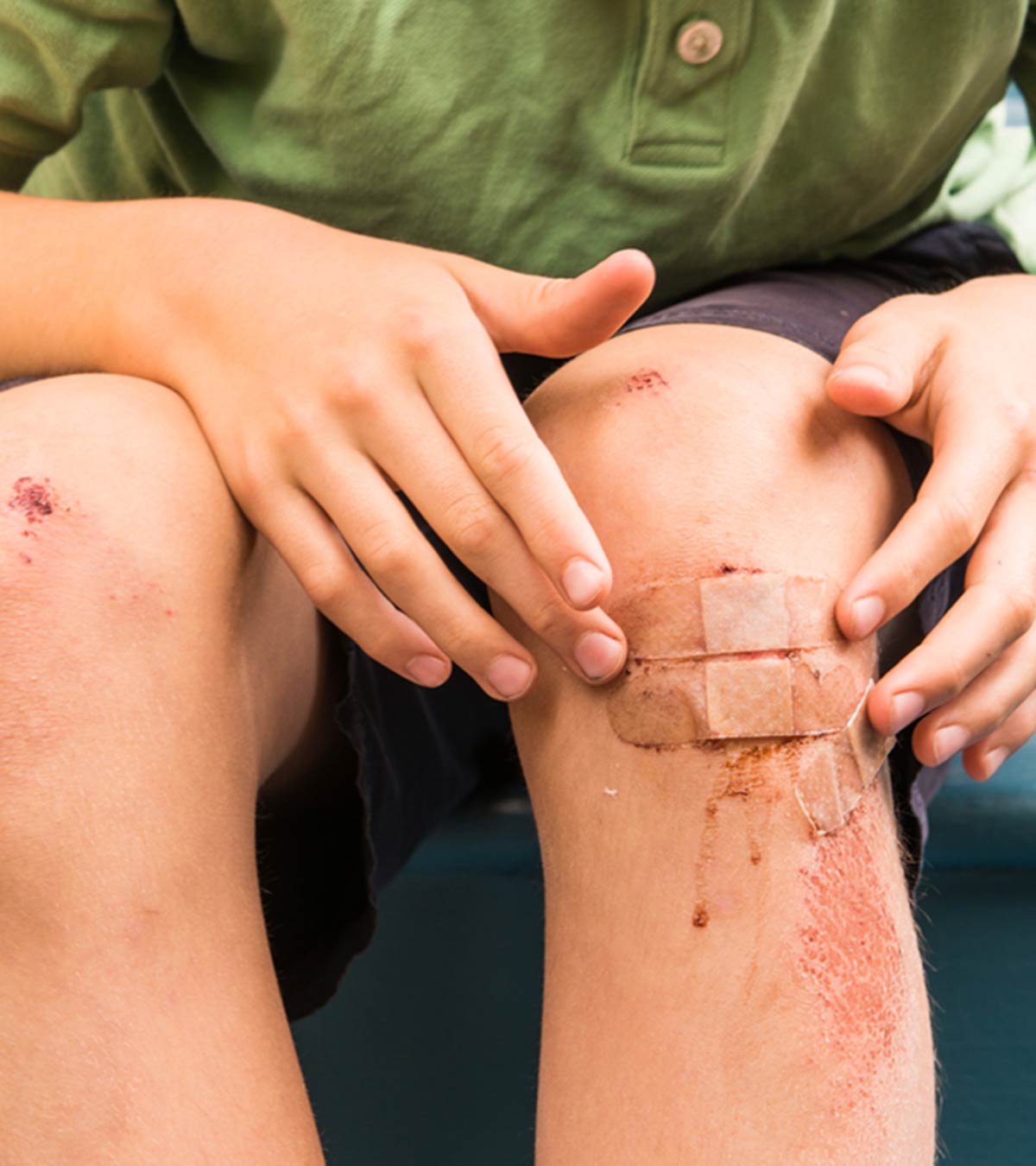 Abnormal Bruising In Children: Signs, Causes And Treatments