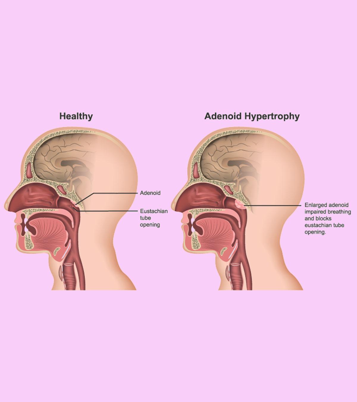 Enlarged Adenoids In Children: Symptoms, Removal & Treatment