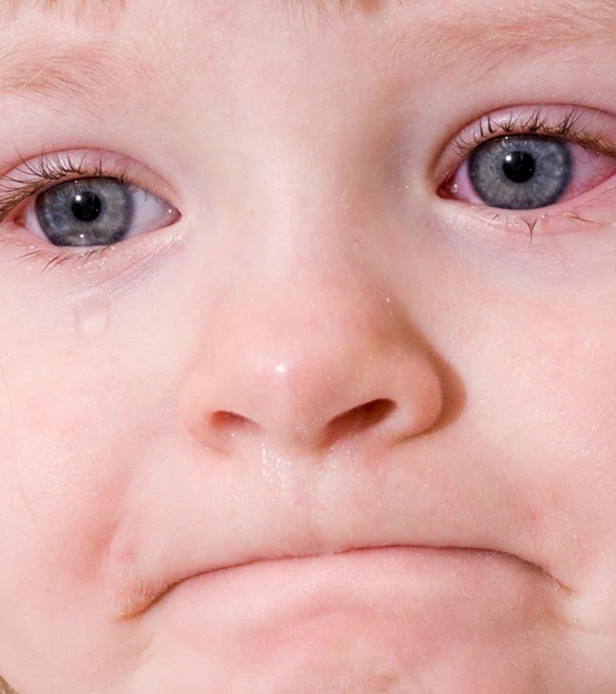 A Kid Suffering From Pink Eye