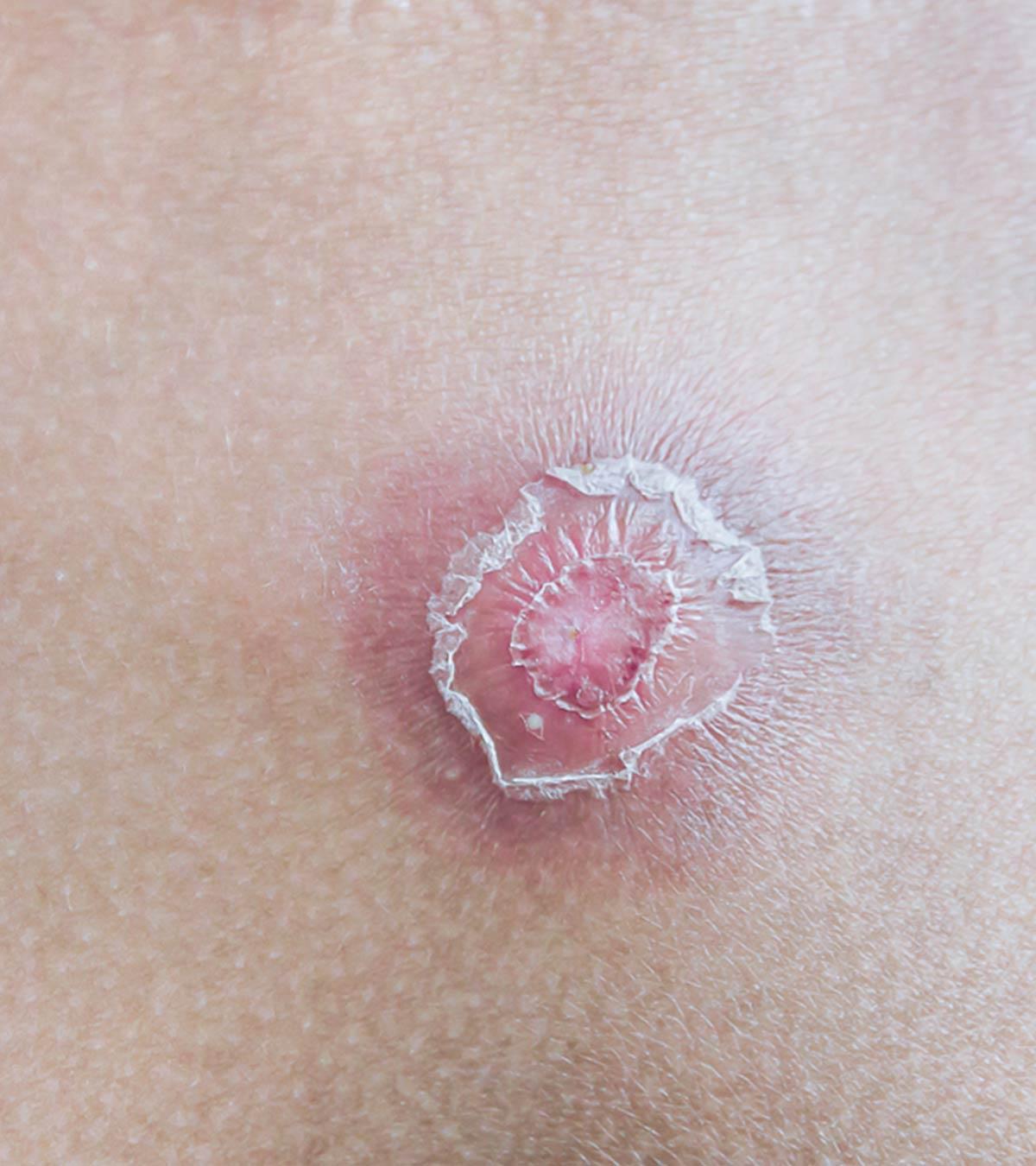 Causes Of Skin Abscess In Children