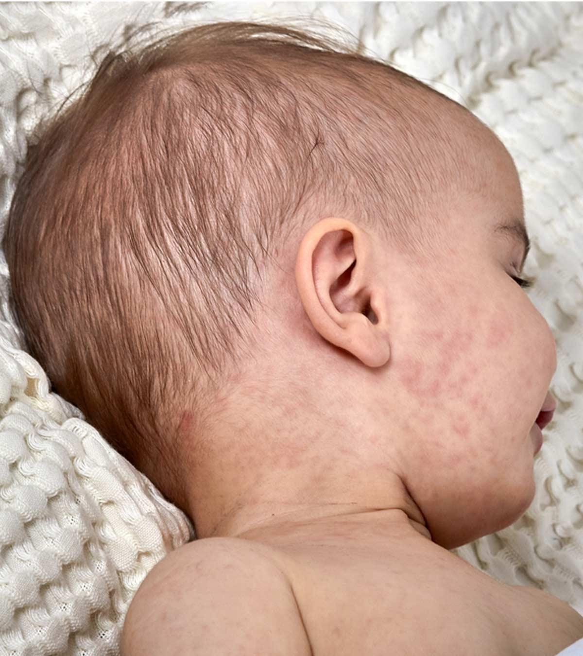 Baby With Viral Rashes