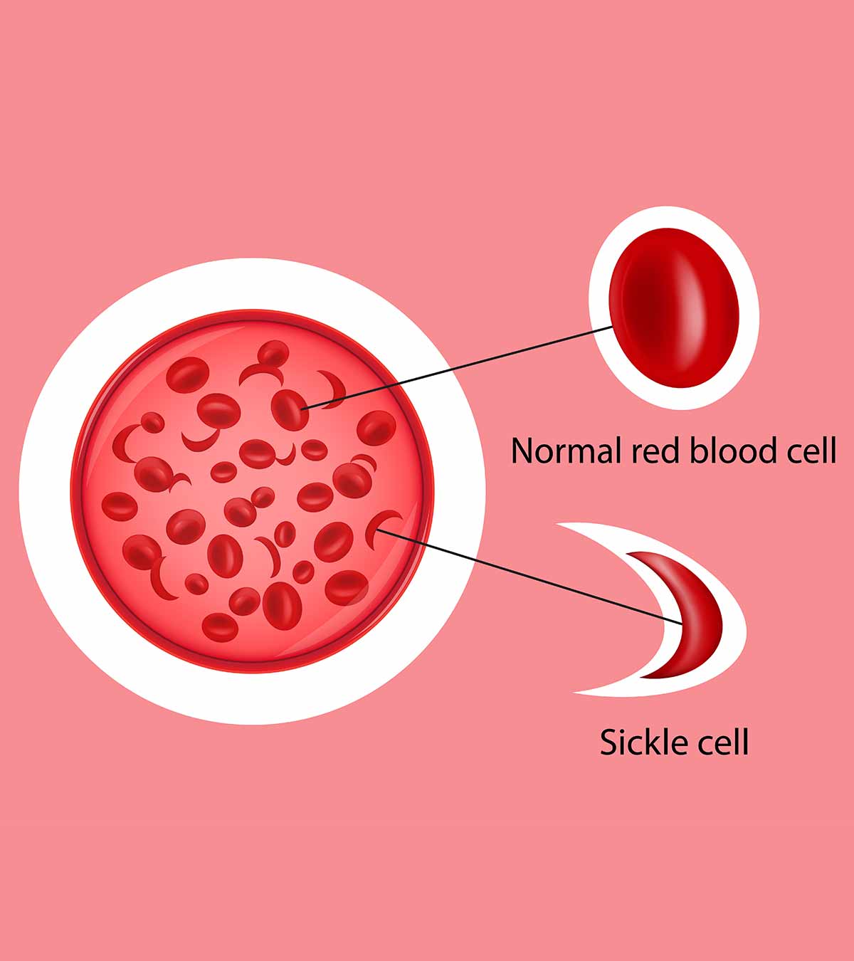 9 Signs And Symptoms Of Sickle Cell Anemia In Children