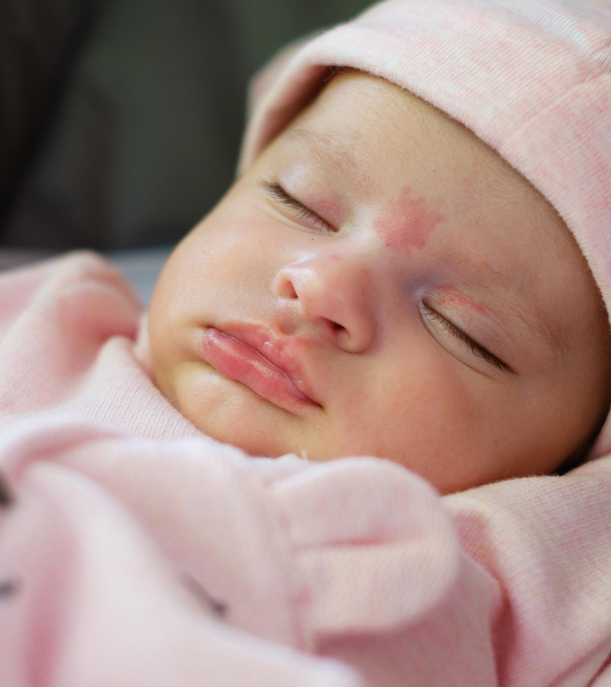 A Baby With Stork Bite Birthmark