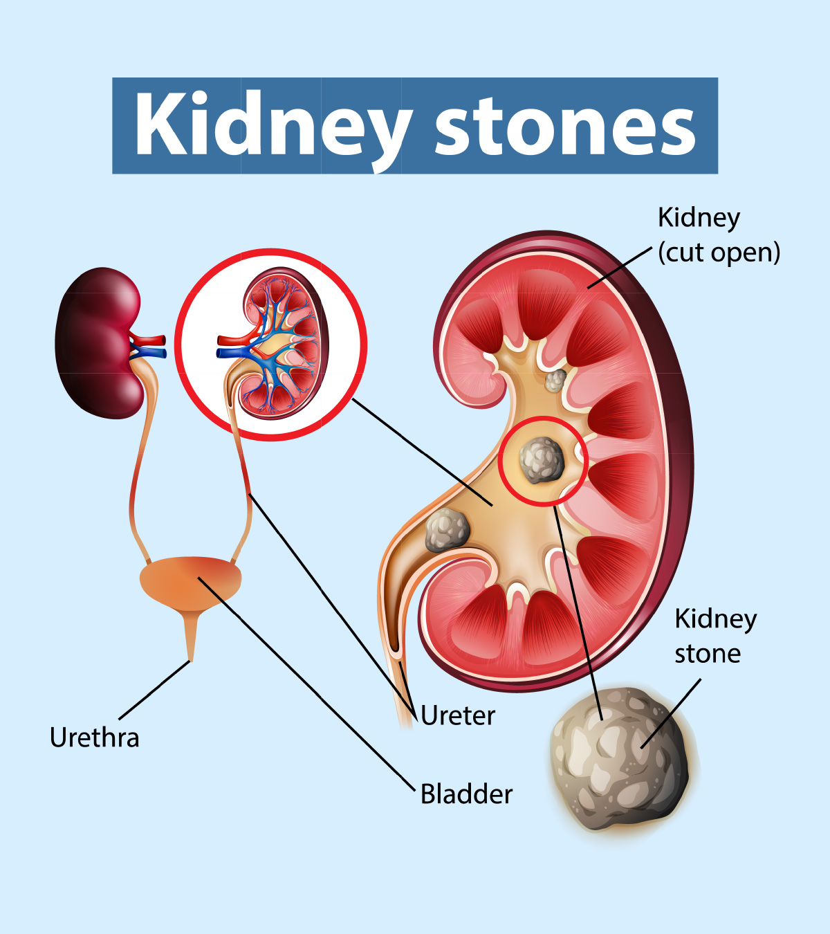 Kidney Stones In Teens: Causes, Symptoms And Treatment