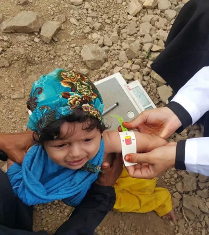 A doctor checking malnutrition in a baby