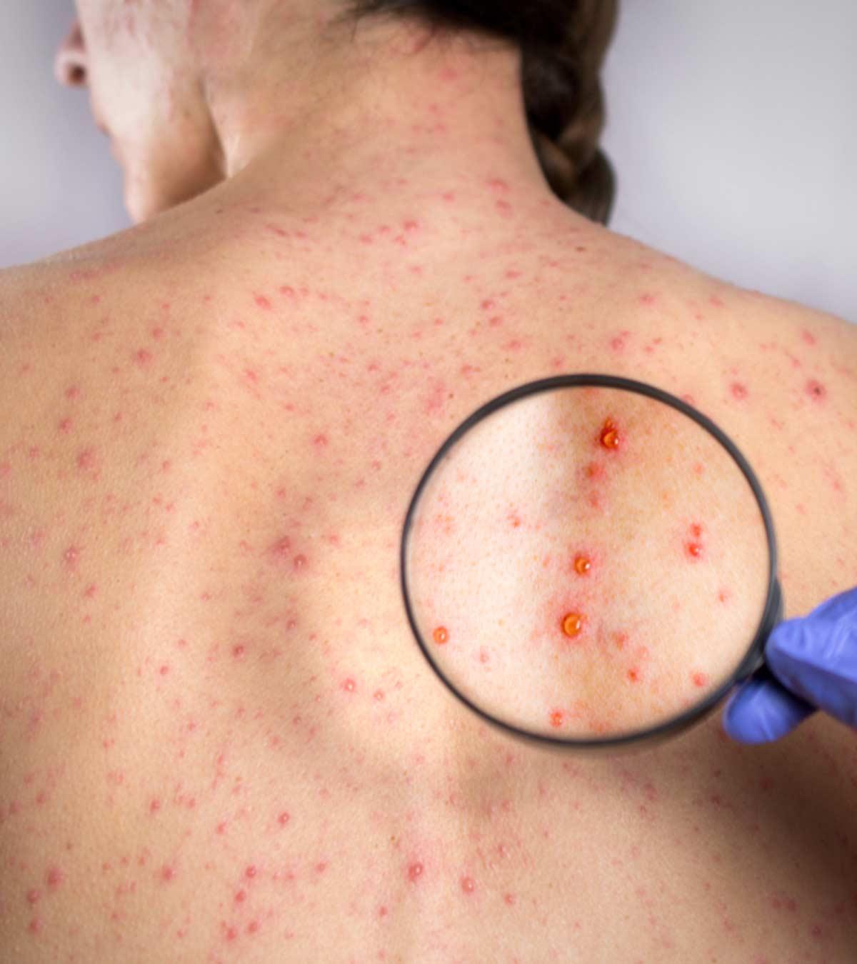 Symptoms Of Rubella In Children