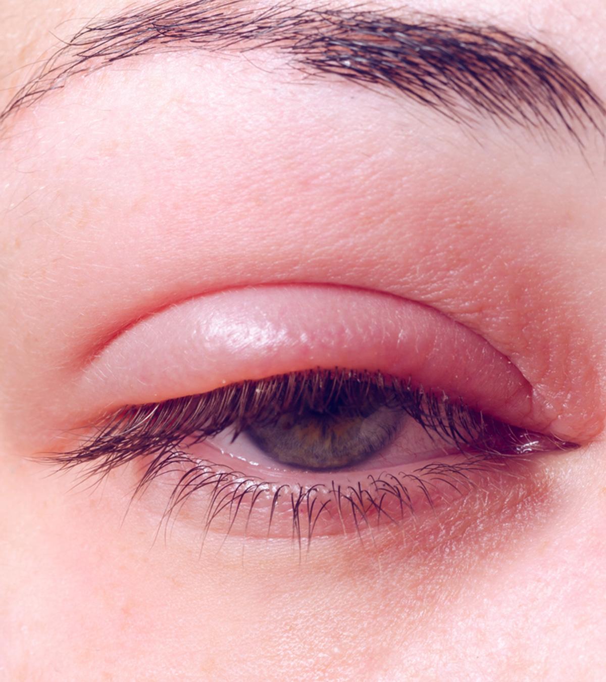 Child With Chalazion On Eye
