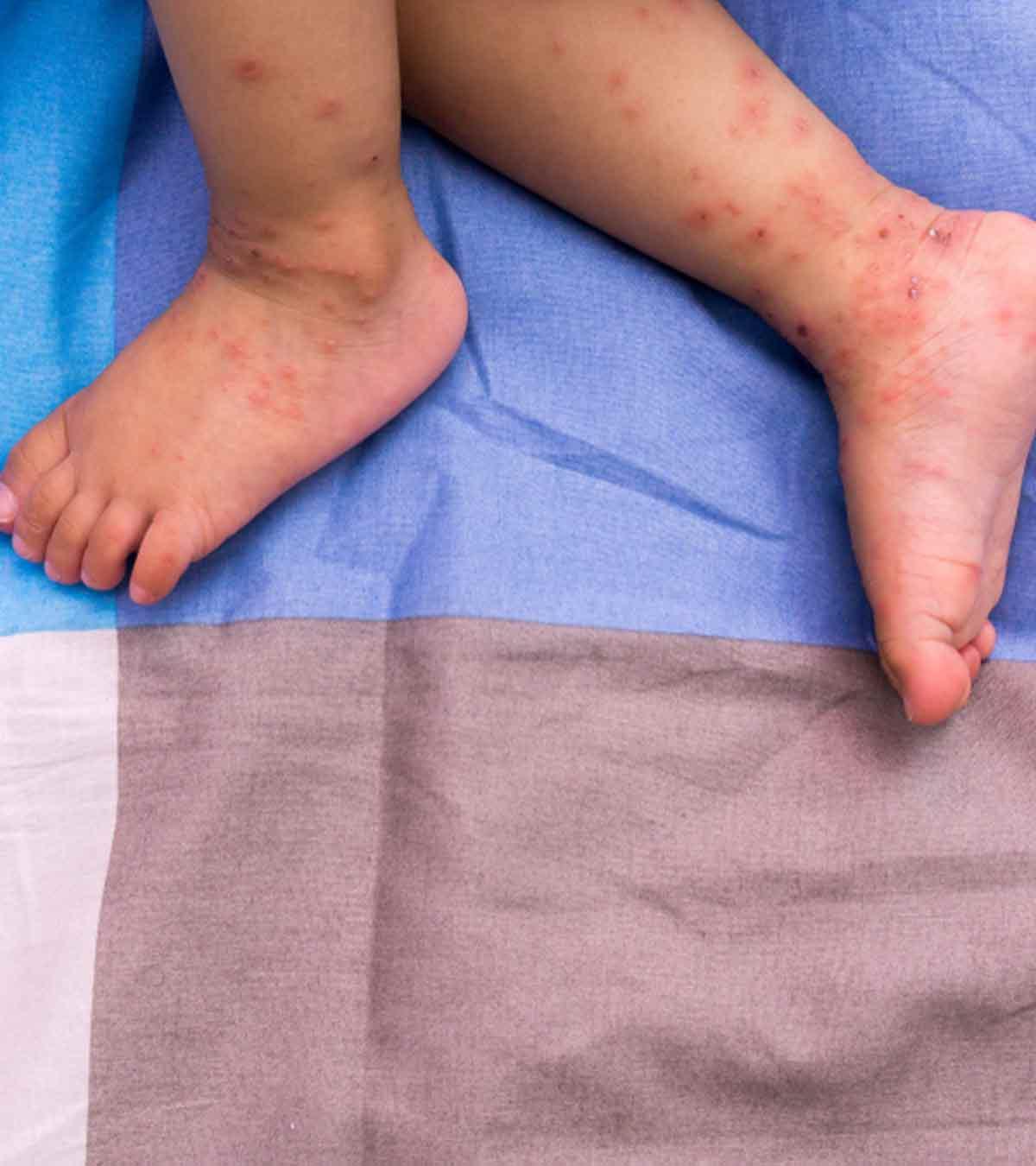 Baby Suffering With With Herpes