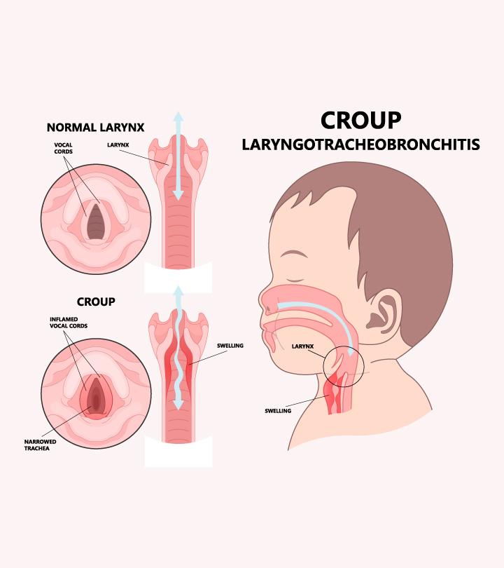 Croup In Children: Symptoms, Causes, Risks And Treatment