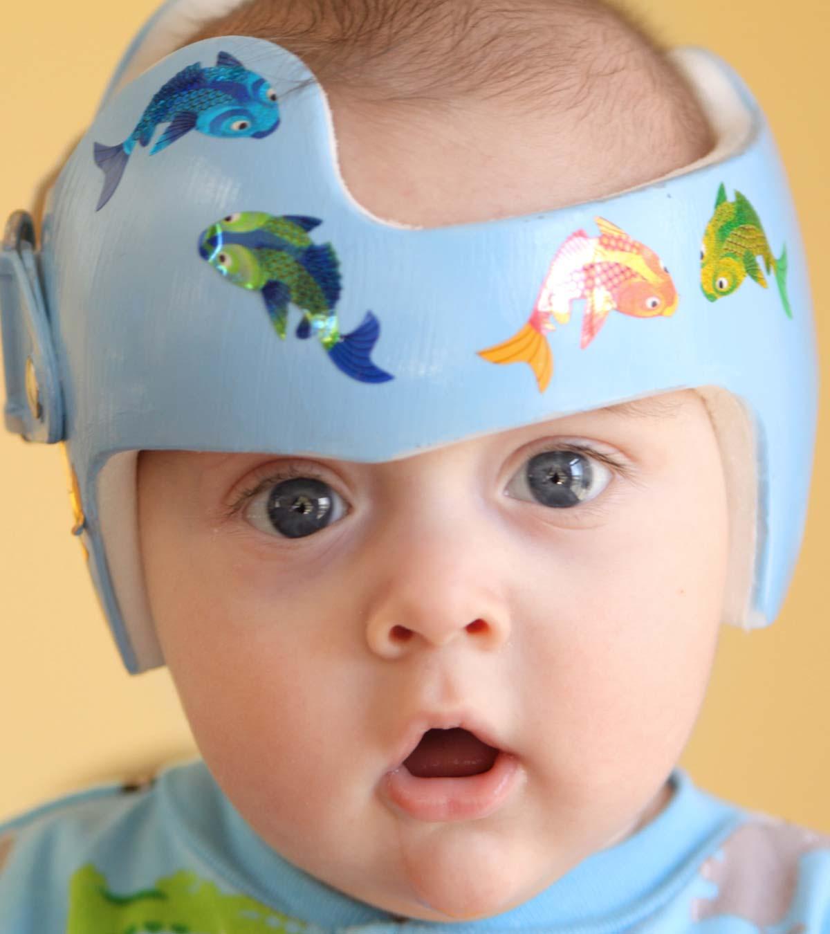 Baby Wearing A Corrective Helmet