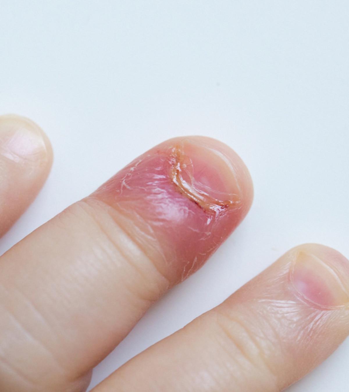 Yeast infection in a child