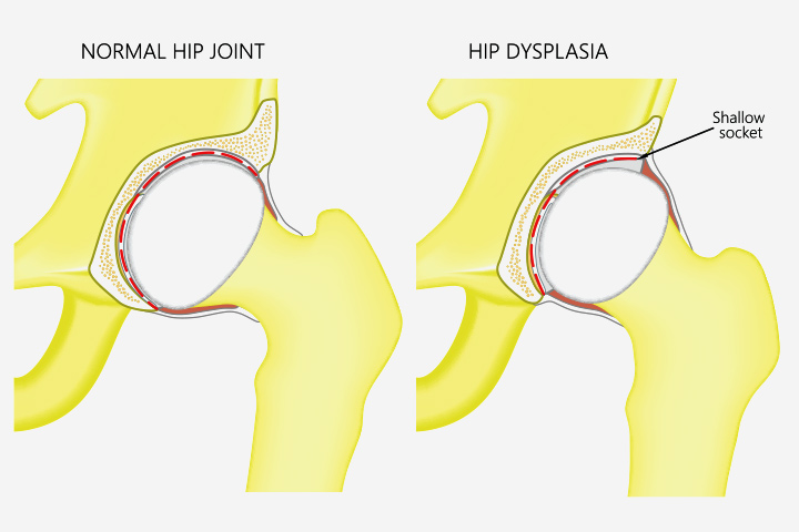 Hip Dysplasia In Babies Causes Signs And Treatment