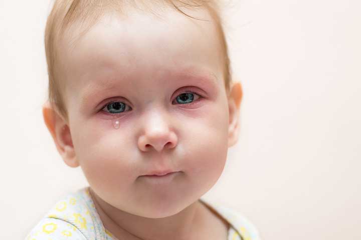 Pink Eye In Toddlers Symptoms, Treatment And Home Remedies