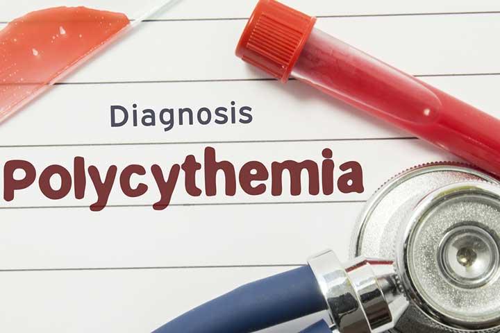 polycythemia in newborn babies symptoms treatment