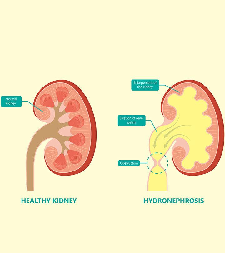 Hydronephrosis in babies