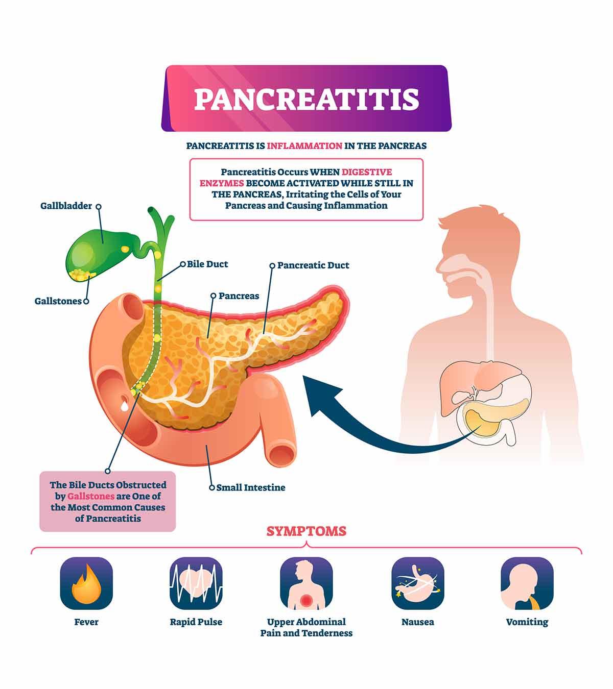Pancreatitis In Children Causes, Symptoms, Diagnosis, And Treatment