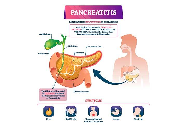 Symptoms Of Pancreatitis In Children, Treatment & Prevention