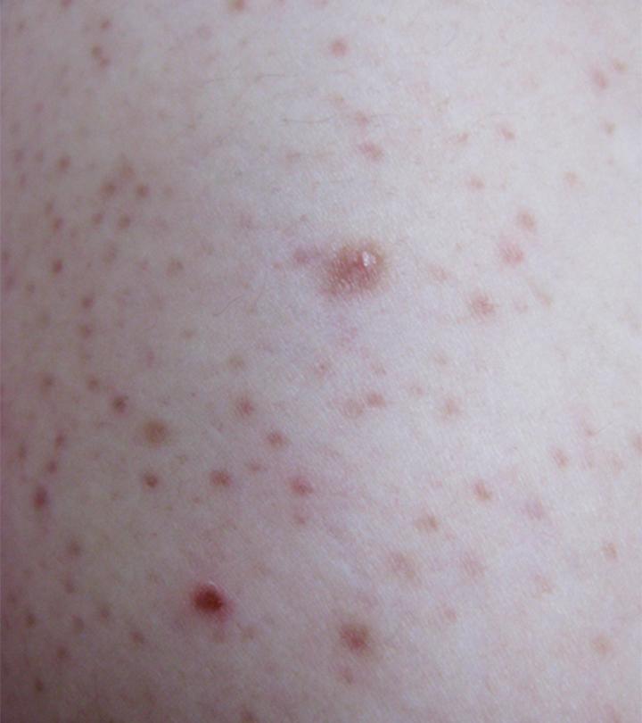 Child With Keratosis Pilaris