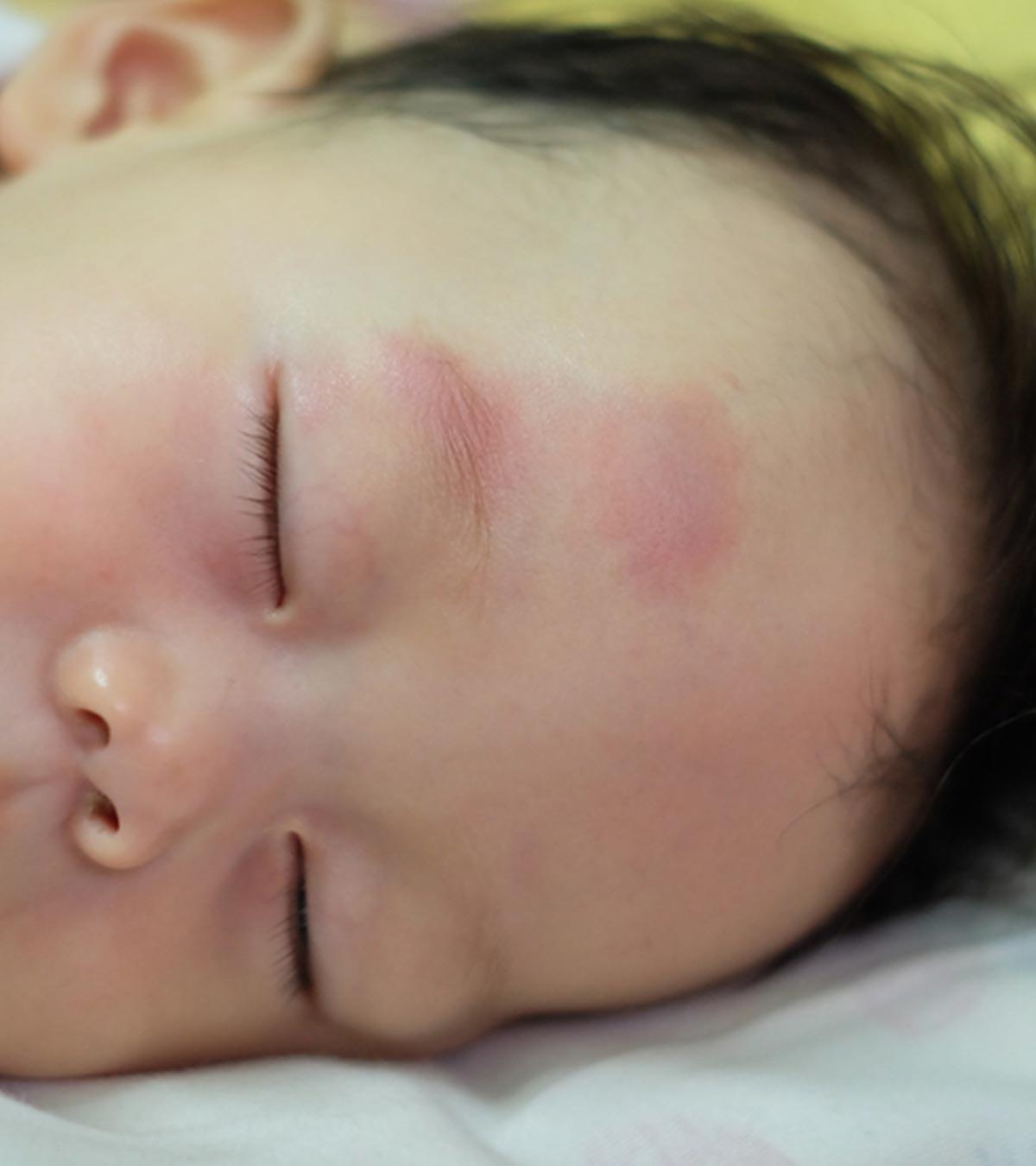 Infant Sleeping With Bruising