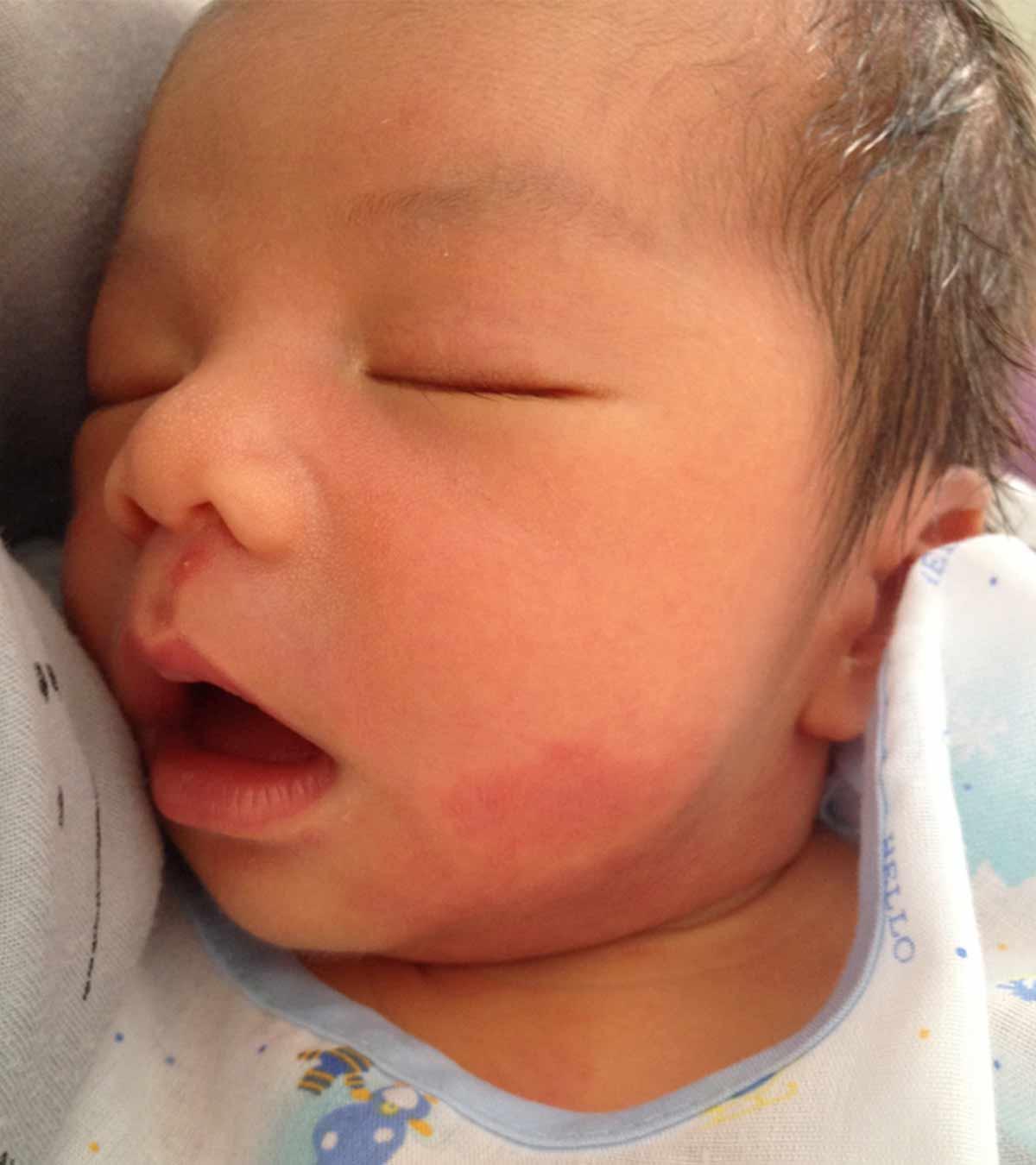 A Baby Having Port Wine Stain On Cheek