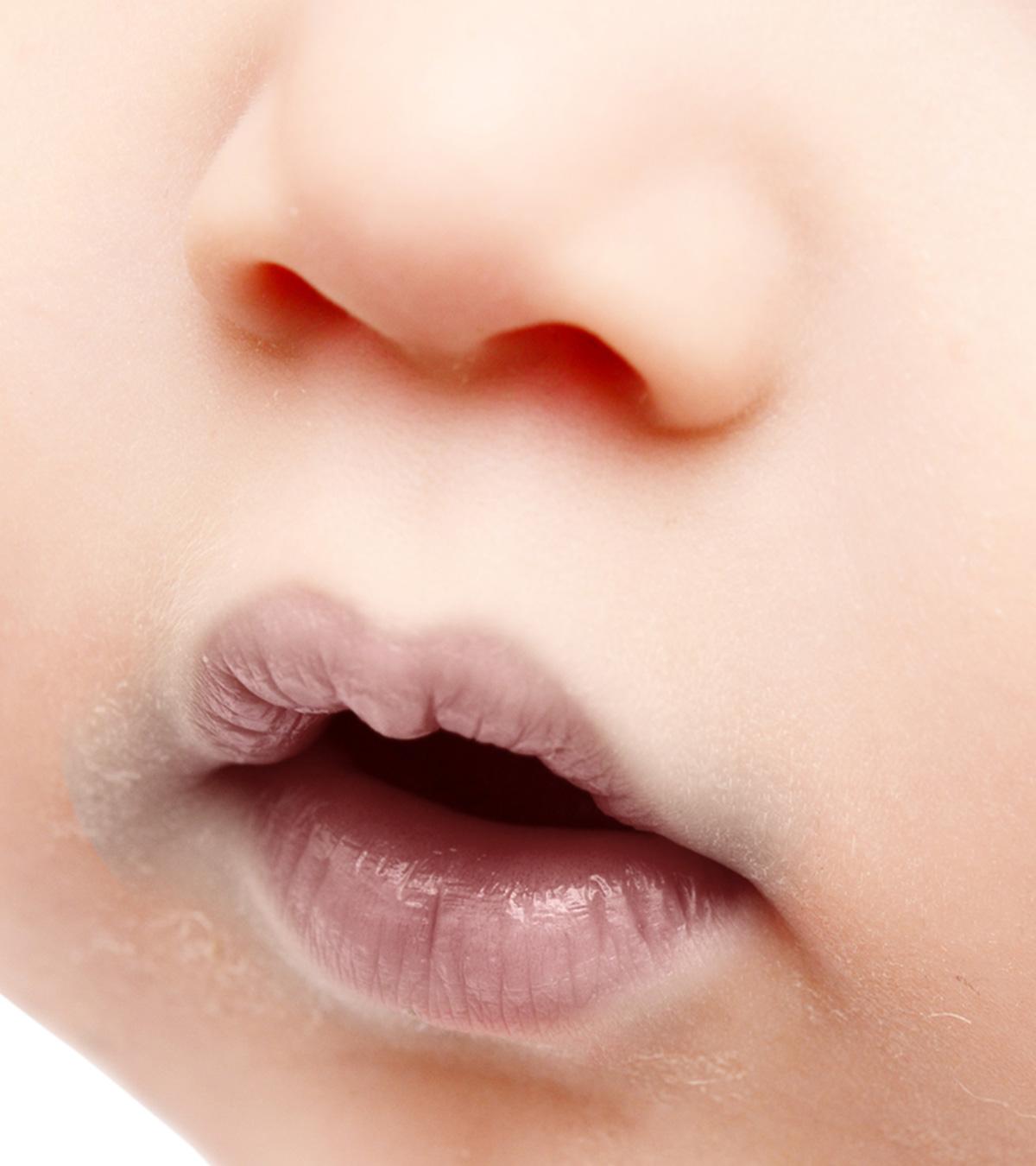 Circumoral Cyanosis In Babies