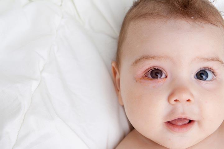 Swollen Eyes In Babies Causes Home Remedies Treatment