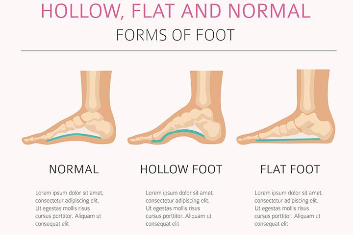 is flat foot a disability is flat foot a disability