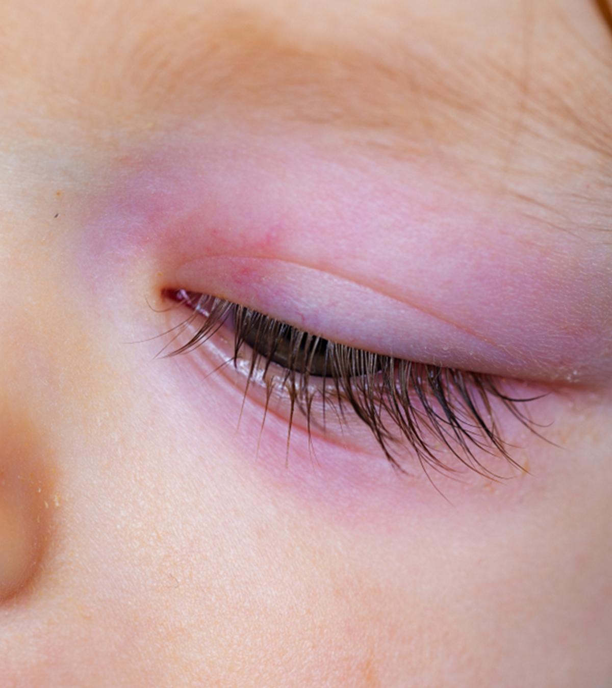 A Baby With Swollen Eyes