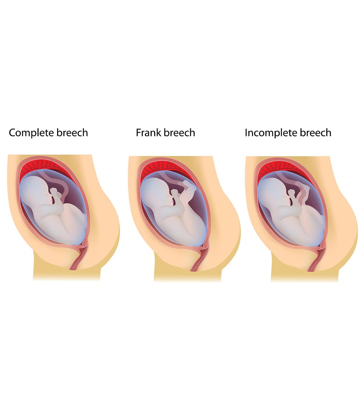 Breech Baby Birth Defects – Breech Presentation: Types, Causes, Risks ...