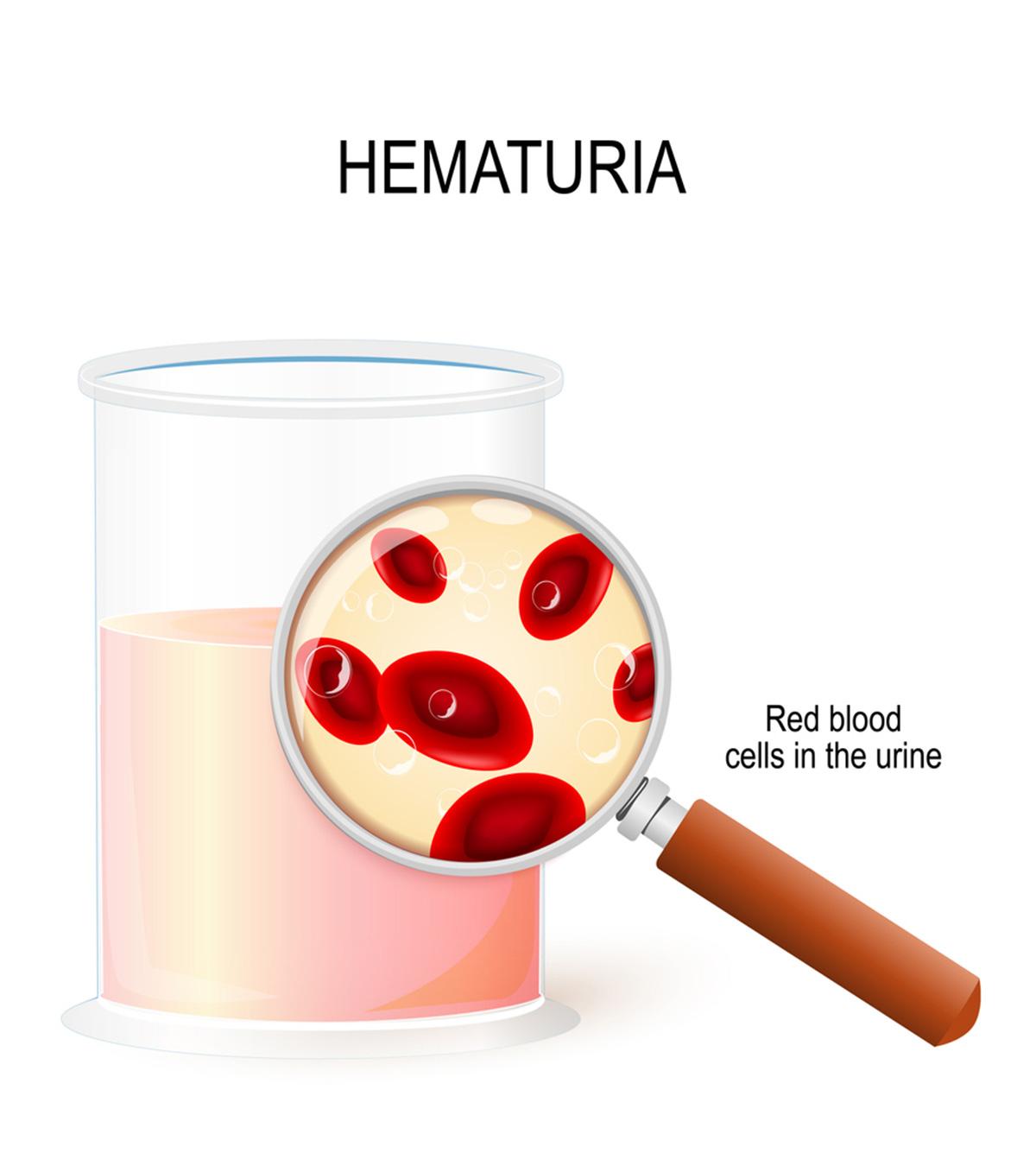 Blood In Urine In Children