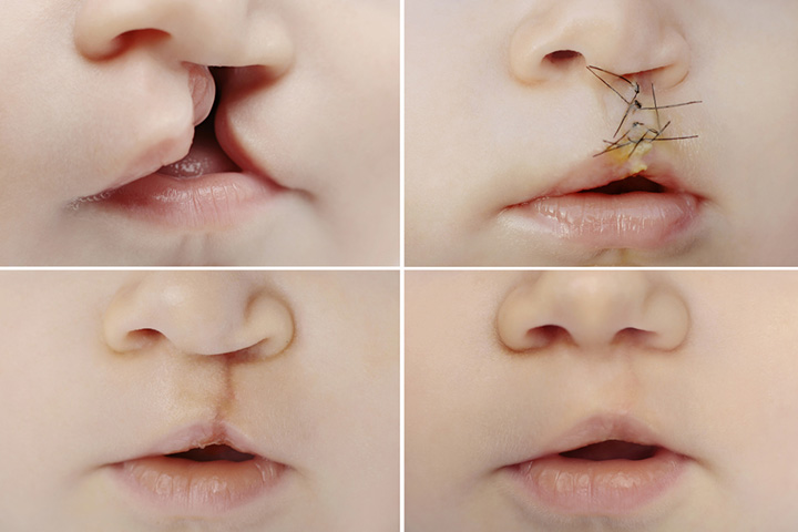 Cleft Lip And Palate In Babies Causes, Diagnosis and Treatment
