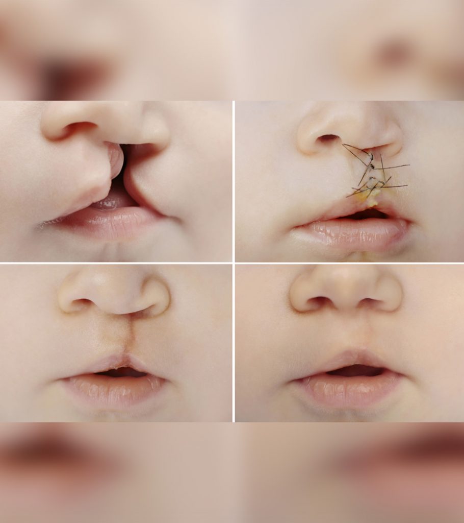 Cleft Lip And Palate In Babies Causes Diagnosis And Treatments 910x1024