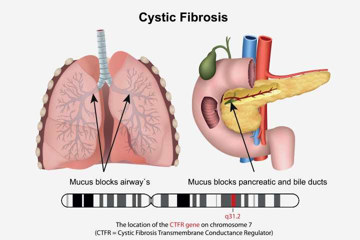 Cystic Fibrosis In Babies
