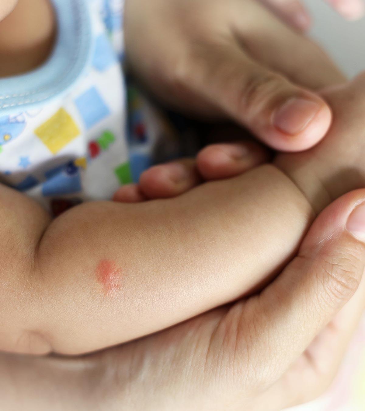 A baby suffering from malaria