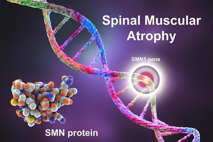SMA Spinal Muscular Atrophy In Babies Causes And Treatment sma-spinal-muscular-atrophy-in-babies-causes-and-treatment