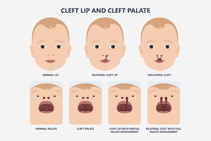Types Of Cleft Lip And Palate