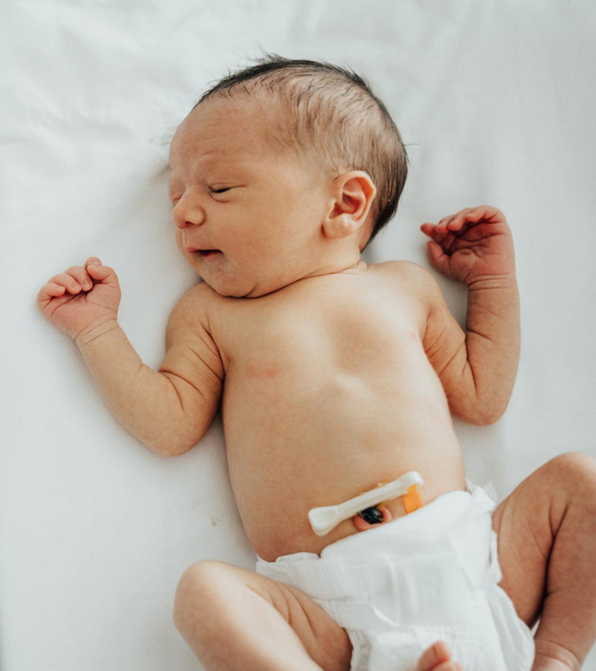 Baby With Umbilical Cord Infection