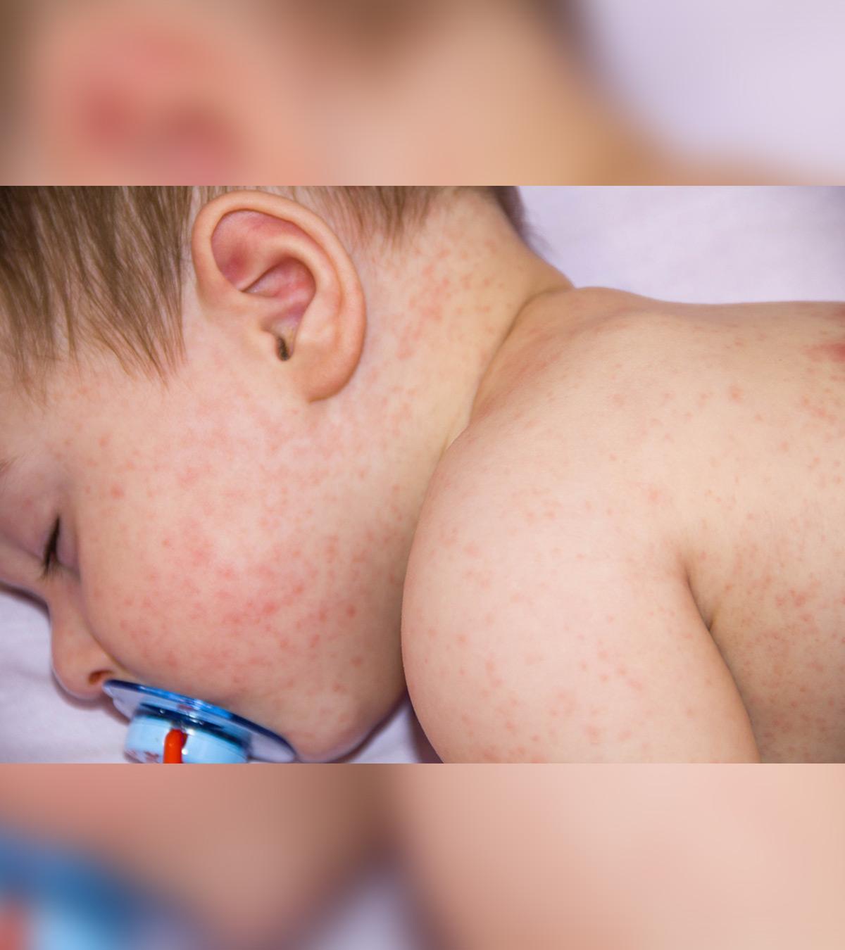 A Toddler Suffering From Rashes After Fever