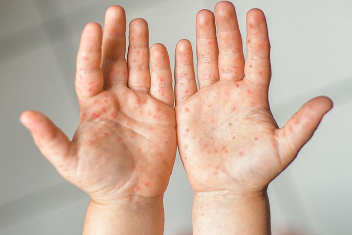 Toddlers with HFMD may develop red spots on the palms and soles