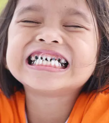 बच्चों के दांतों में कीड़े :  कारण, लक्षण, ट्रीटमेंट व  घरेलू उपाय | Tooth Decay In Kids In Hindi