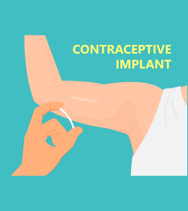 Benefits Of Birth Control Implant