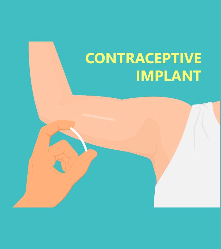 Birth Control Implant: Benefits And Side Effects